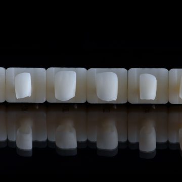 How Can Cosmetic Veneers Reduce Your Gummy Smile?
