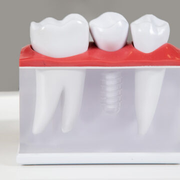 Top Recovery Foods After Dental Implant Surgery