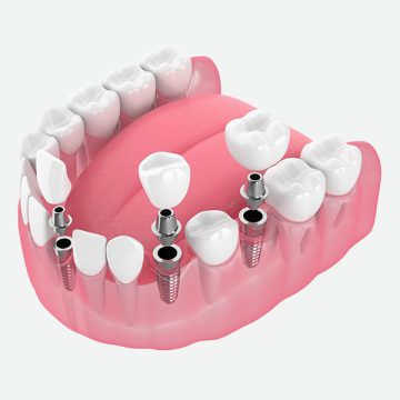 How Implant-Supported Bridges Improve Smile Stability and Function