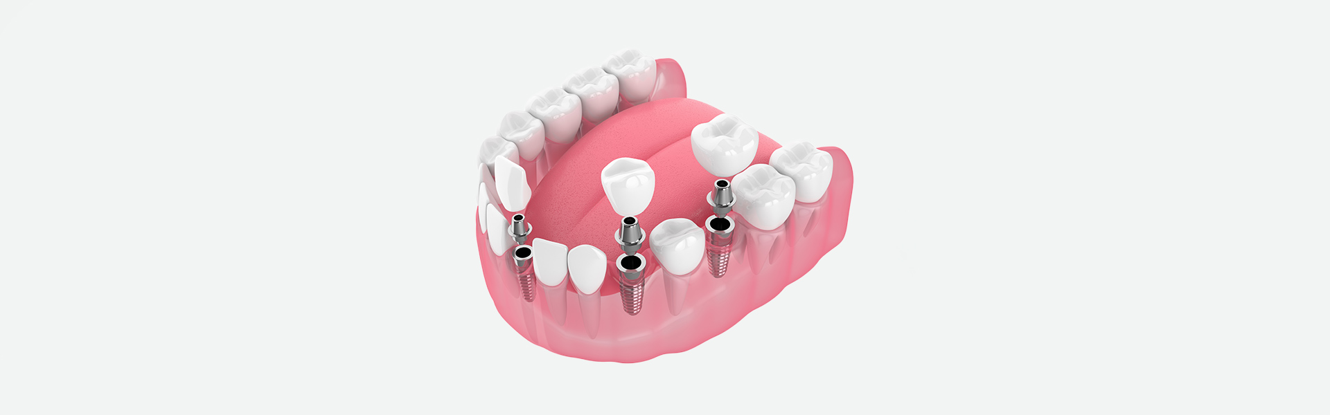 How Implant-Supported Bridges Improve Smile Stability and Function